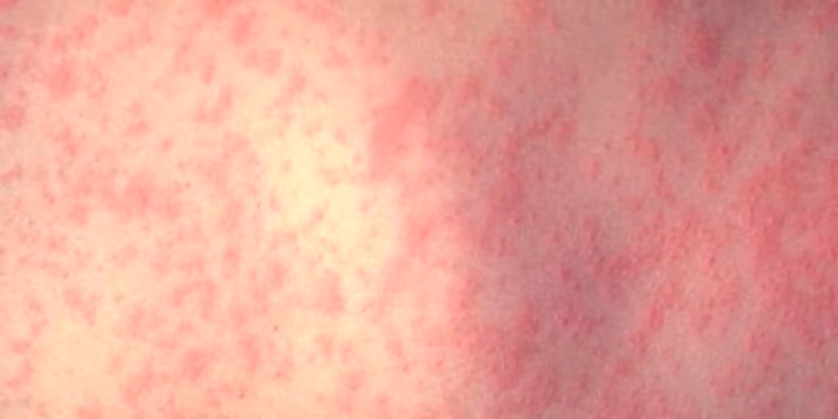 Featured image for Louisiana Reports Third Measles Case of 2025 at MSY Airport