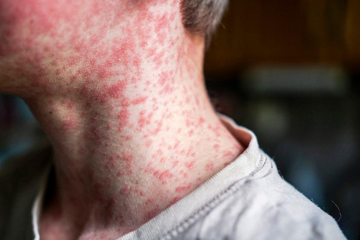 Featured image for Measles Outbreak in South Carolina Raises Public Health Concerns