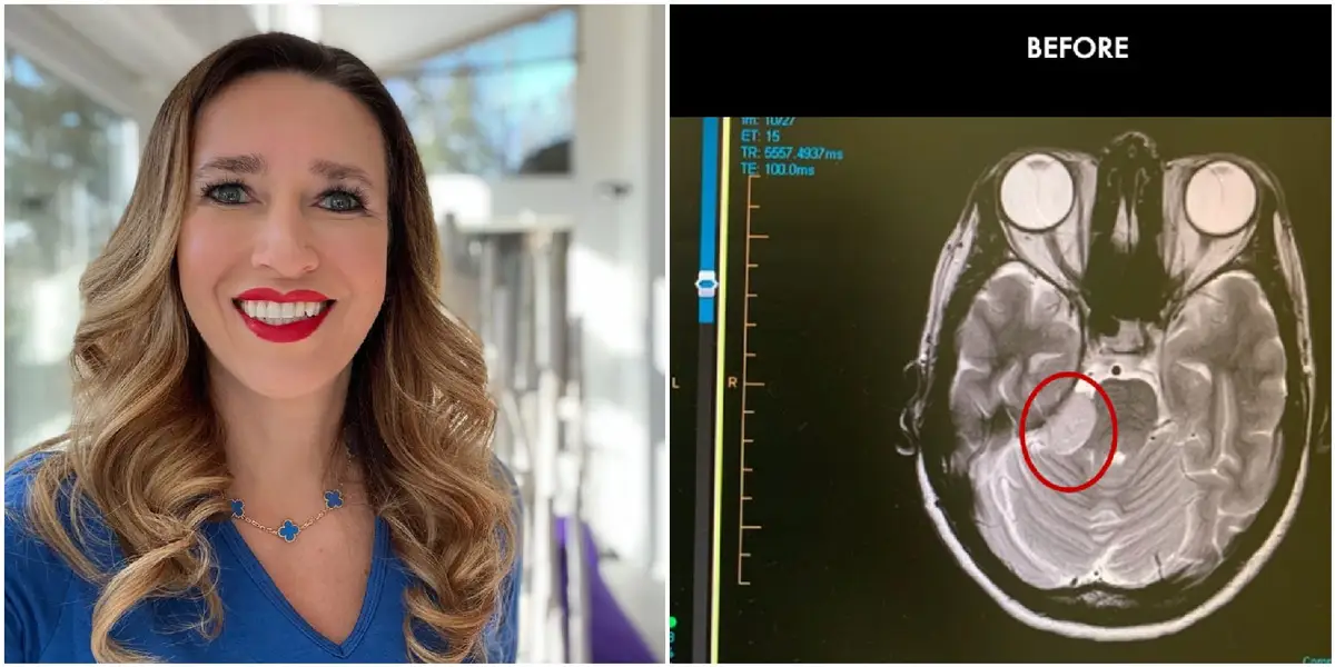 Featured image for Decade-long brain tumor causes intense facial pain for woman and mother.