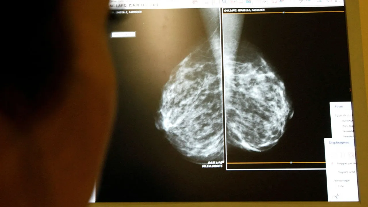Featured image for AI model predicts spread of aggressive breast cancer.