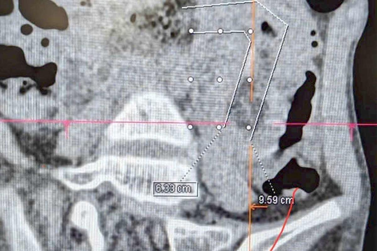 Featured image for Doctors Remove Large Hairball From Girl After Years of Hair Eating