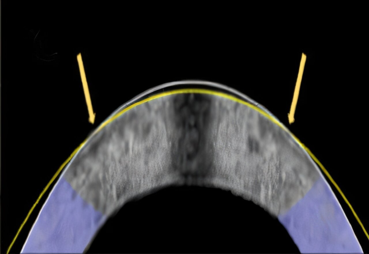 Featured image for Laser-Free Alternative to LASIK for Vision Correction