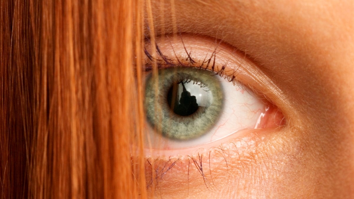 Featured image for Red Hair Gene Linked to Chronic Wound Healing Issues