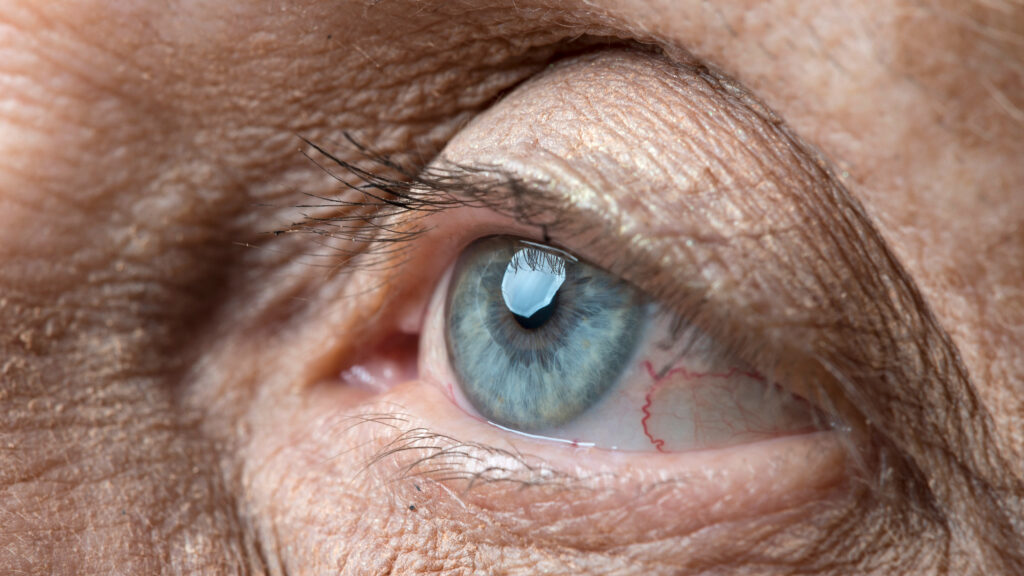 Featured image for Ocular Therapeutix Prepares for Key Trial of Longer-Lasting Eye Treatment