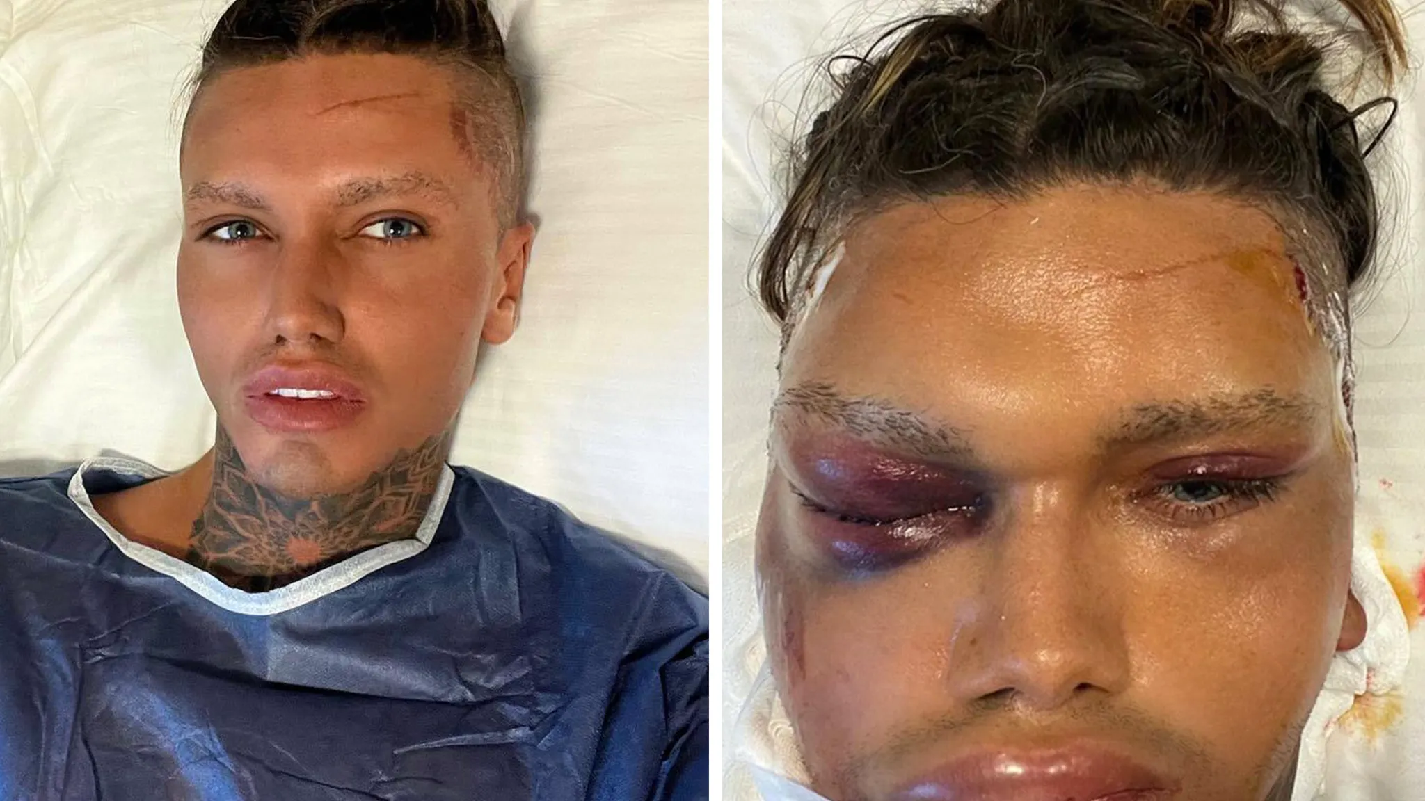 Featured image for "TikTok Star's Dramatic Transformation: Five Simultaneous Plastic Surgeries Revealed"