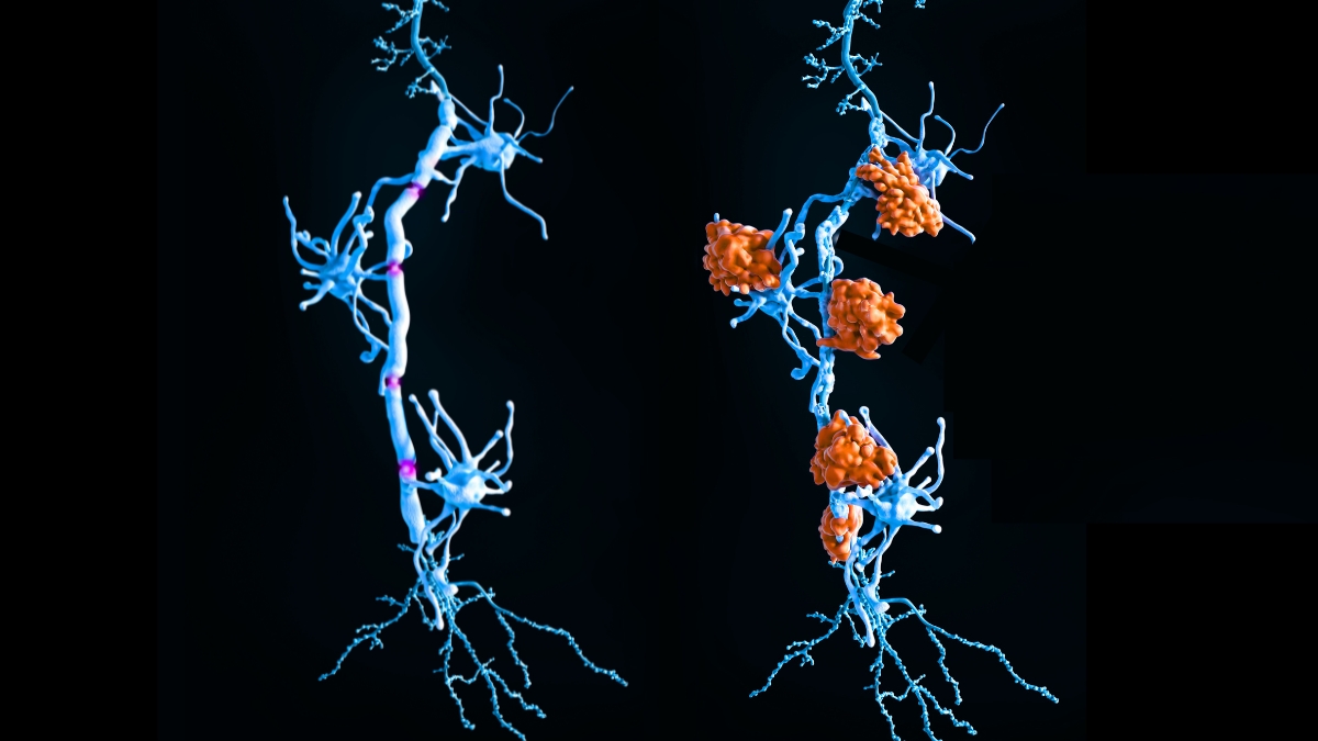 Featured image for AI Reveals Two Distinct Subtypes of Multiple Sclerosis