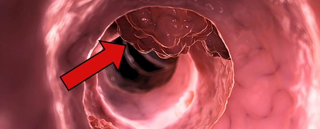 Featured image for Aspirin Significantly Reduces Colorectal Cancer Recurrence