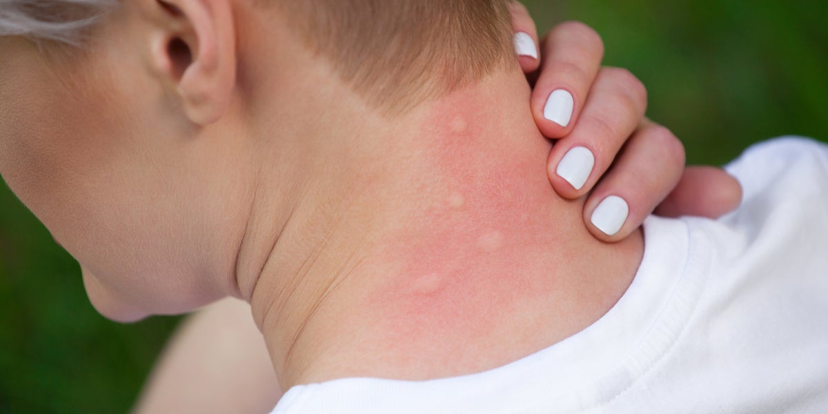 Featured image for Why Mosquitoes Prefer Certain People