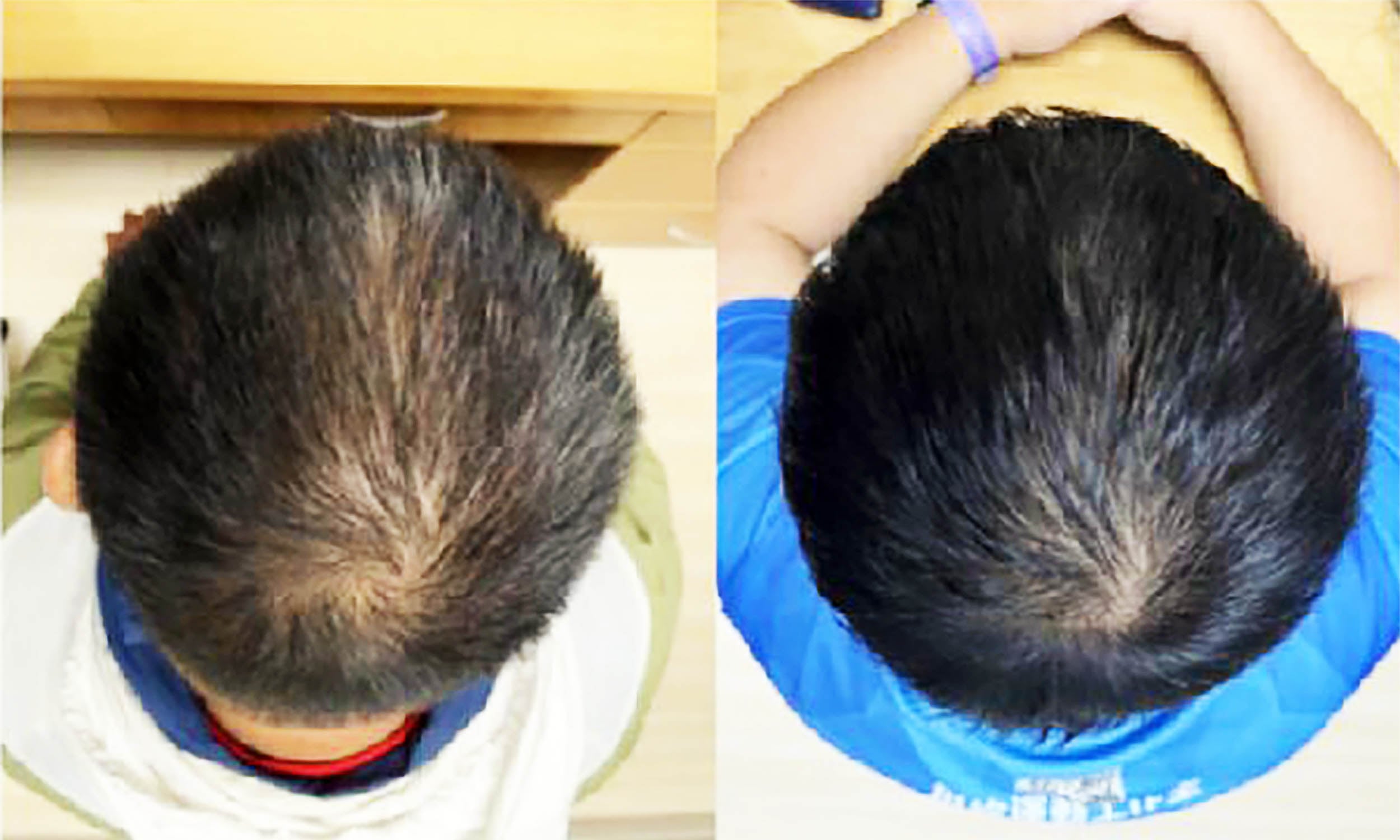 Featured image for Plant-Based Serum Promotes Rapid Hair Regrowth, Scientists Find