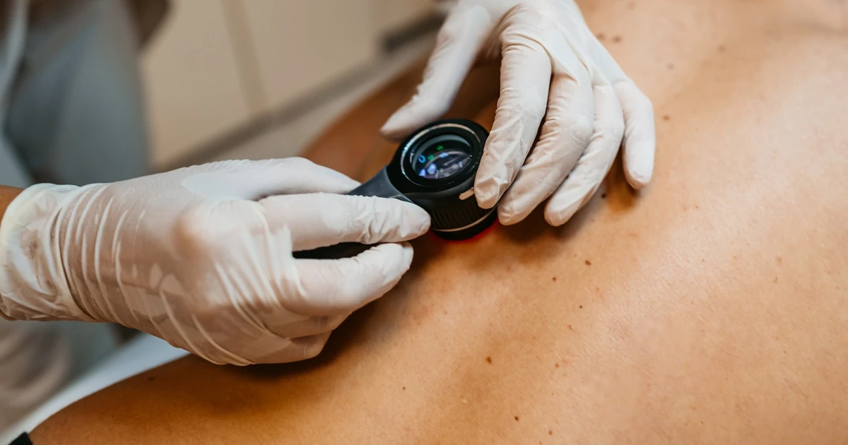 Featured image for Promising results from skin cancer vaccine trial.