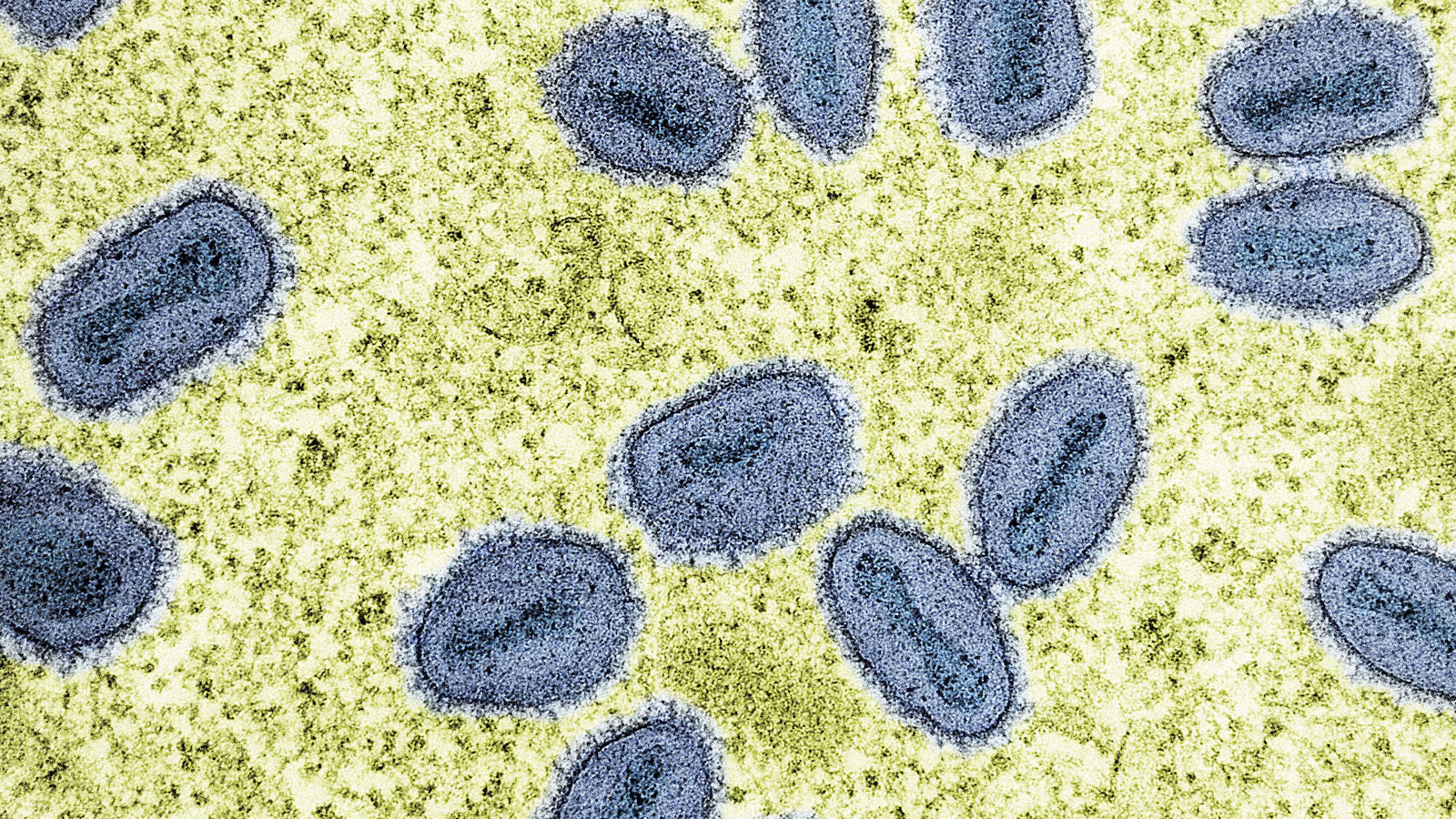 Featured image for First US Cases of Severe Mpox Strain Detected in California